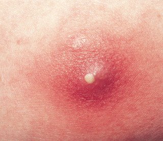 Slide show: Common skin rashes - Mayo Clinic