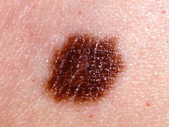 Interesting Facts Is It Skin Cancer 38 Photos That Could Save Your Life