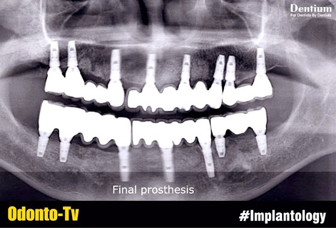 IMPLANTOLOGY: Full mouth rehabilitation using Dentium implant system simultaneous GBR