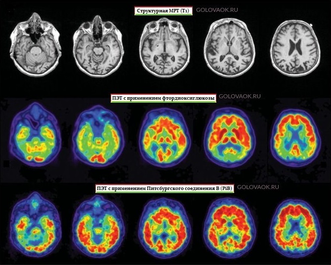 атрофия коры головного мозга мрт. микрогирия мрт. атрофия головного мозга мрт. атрофические изменения коры головного мозга. кортикальная атрофия 1 ст.