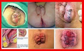benjolan wasir obat wasir alami