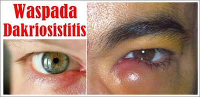 
Pengobatan Tradisional Dakriosistitis Yang Terbaru | Pengobatan Tradisional Skleritis Terbaik
