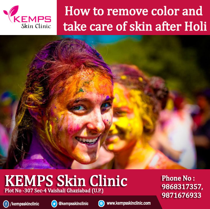 How to remove color and take care of skin after Holi KEMPS Skin Clinic