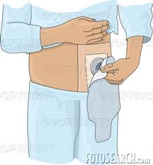 implementing measures colostomy and ileostomy care ~ Link Nurses
