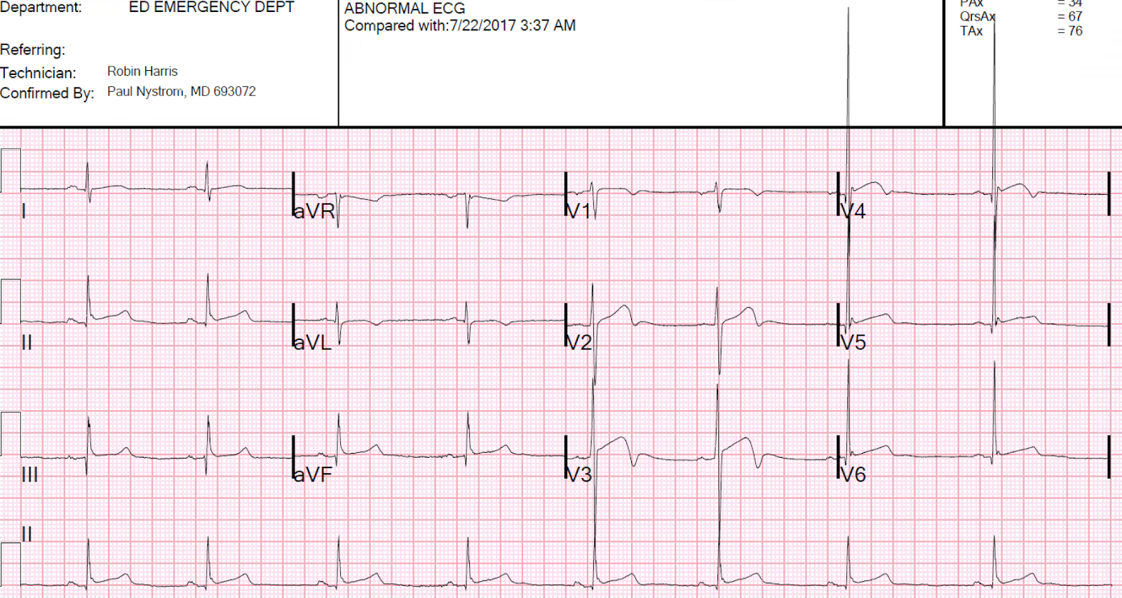 Dr. Smith's ECG Blog 2 Cases of Resolved Chest Pain with Dynamic