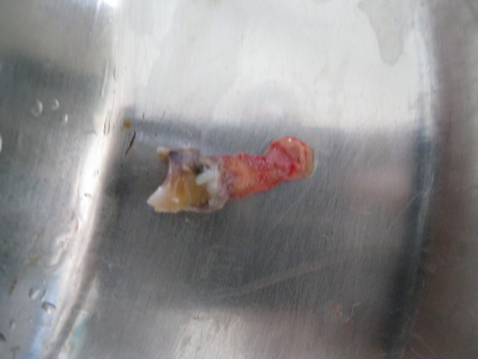 DENTO CARE DENTAL CLINICS Radicular CystAfter Extraction