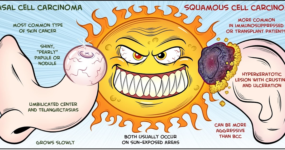 Basal Cell Carcinoma A skin problem