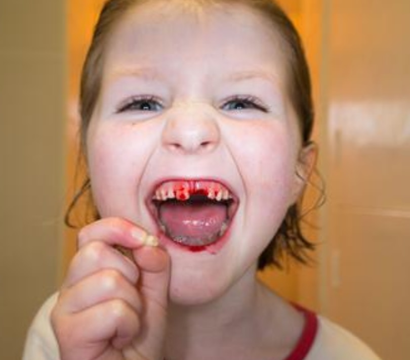 How To Stop Bleeding After Tooth Extraction With Tea Bag / Tea Bags And