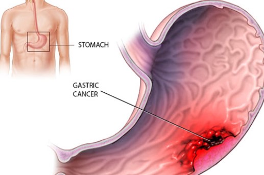 Diffuse gastric cancer  symptoms and causes