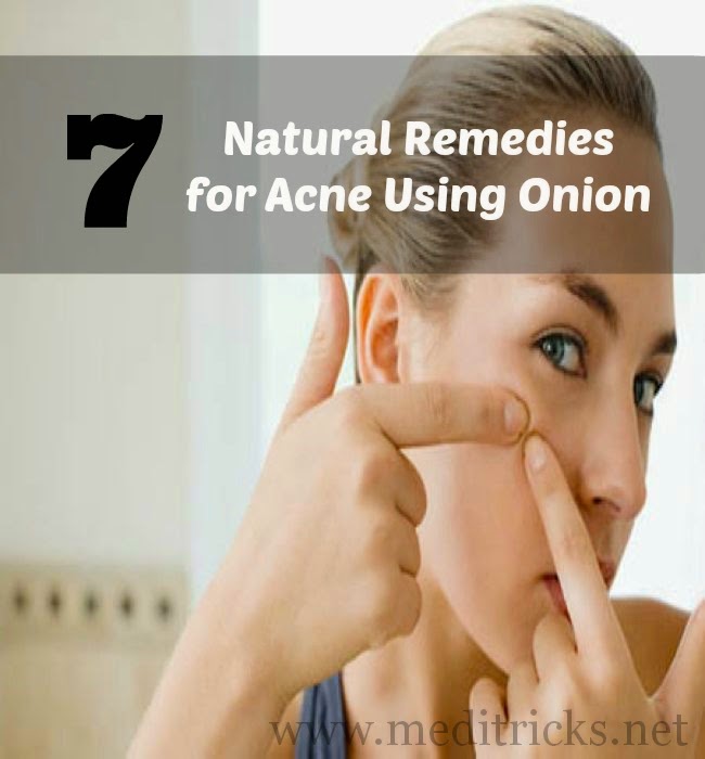 Natural Remedies for Acne Using Onion Medi Tricks