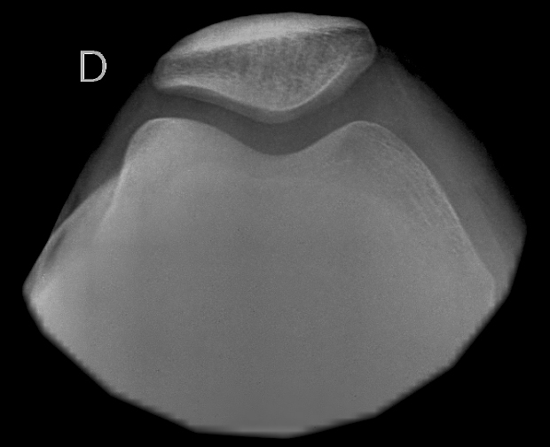 Rx Assiali Rotula 30 60 90 Tu Espacio Radiológico: Proyecciones Básicas de Rodilla