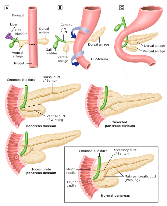 Doctors Network Pancreas Divisum as an indication of Islet transplantation