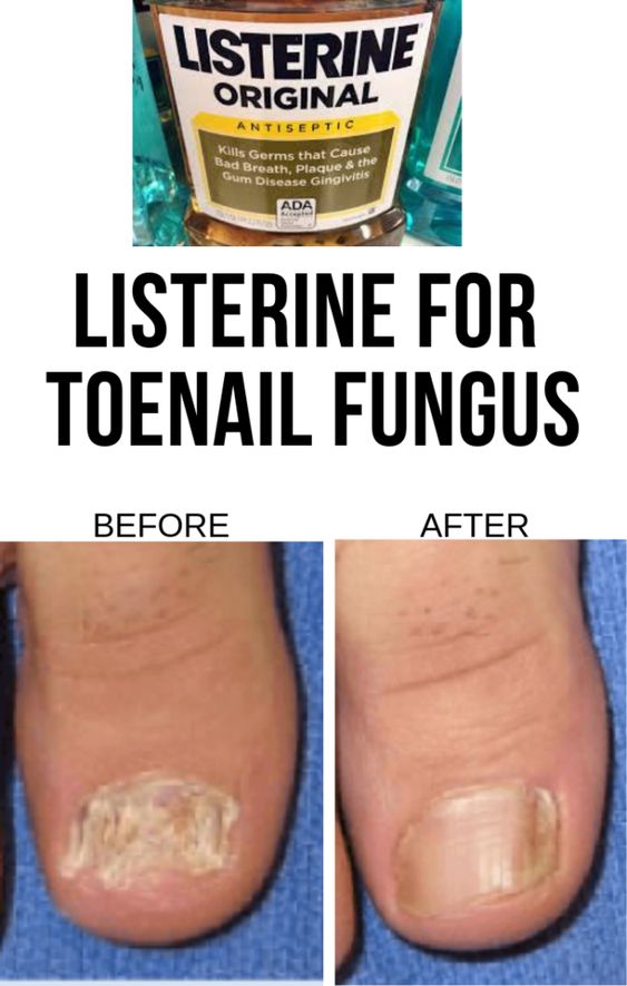 HOW TO USE LISTERINE FOR TOENAIL FUNGUS EFFORTLESSLY | Wellness Gain