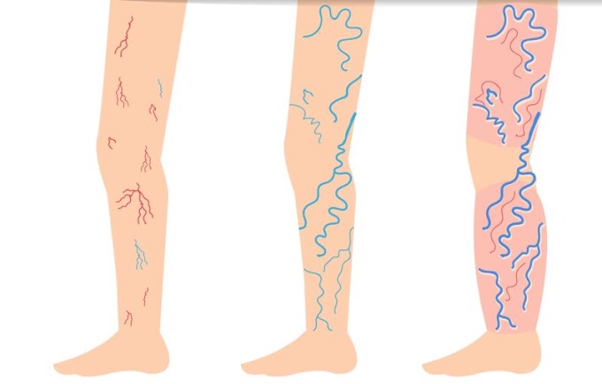 Formas increíblemente sencillas de combatir las varices y arañas vasculares de forma natural