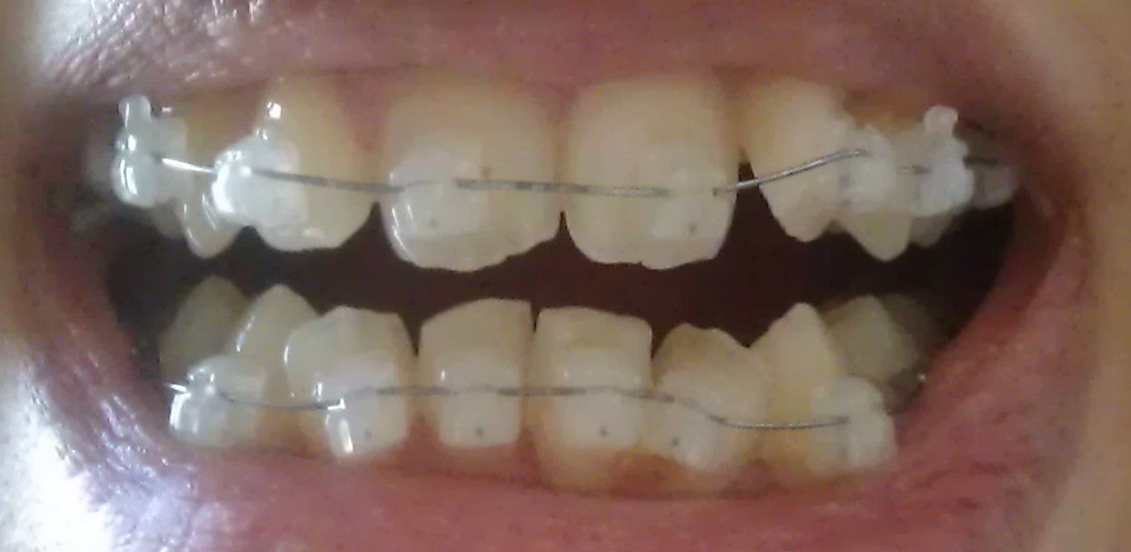  how long to put on damon braces