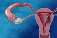 سرطان بطانة الرحم Endometrial cancer
