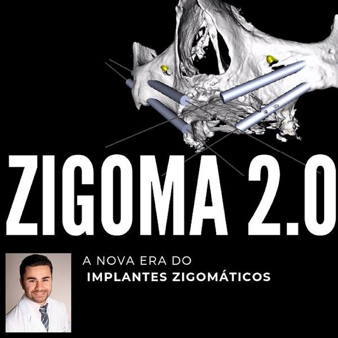 LIVRO: ZIGOMA 2.0 - A Nova Era dos Implantes Zigomáticos: Como aprender, operar e ensinar implantes zigomáticos - Fernando Giovanella