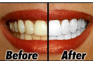 11 Cara Memutihkan Gigi Secara Alami Cepat dan Mudah!