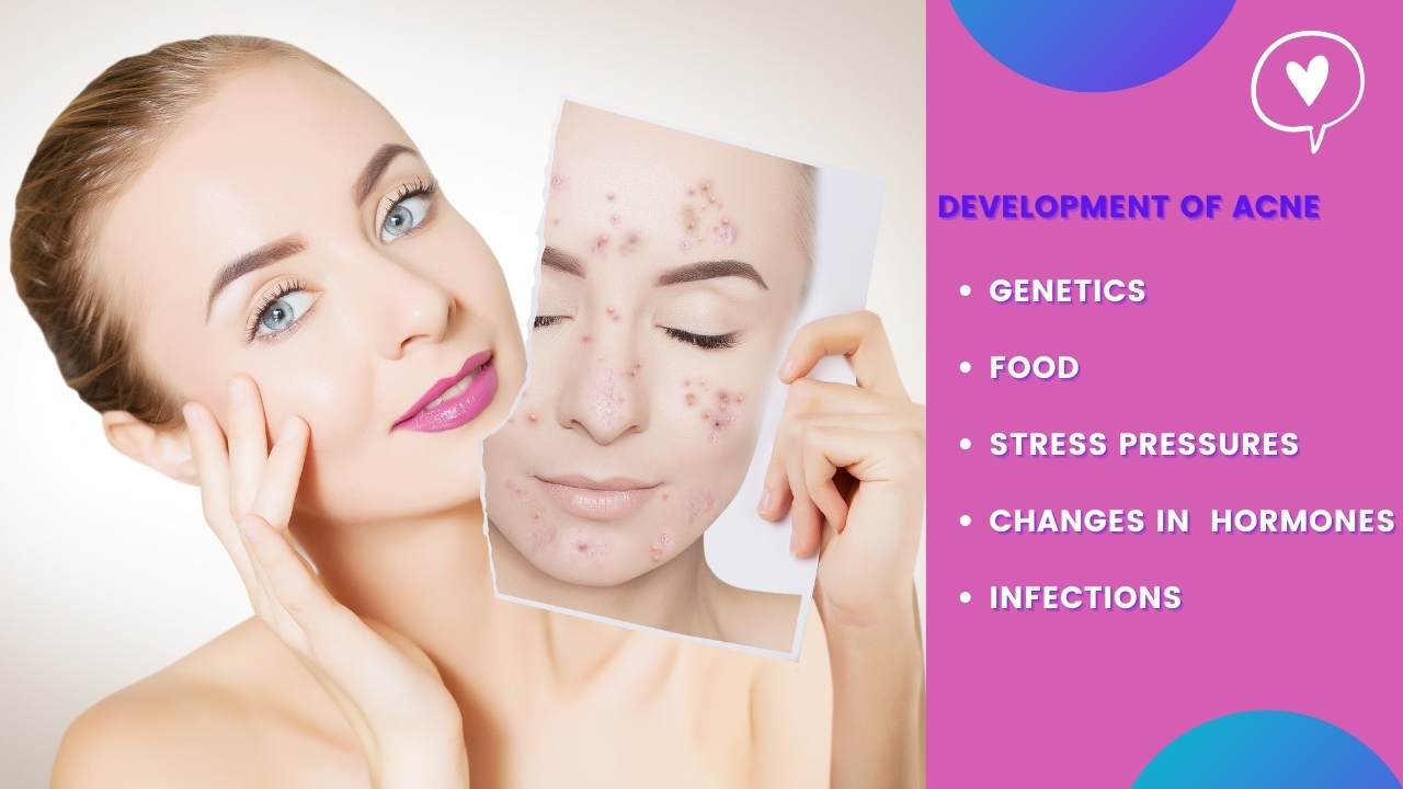 how-to-get-rid-of-acne-in-a-week-with-home-remedies