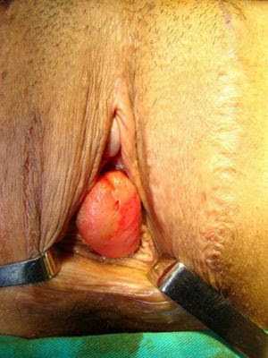 Prolapse of bulbar urethra is visible