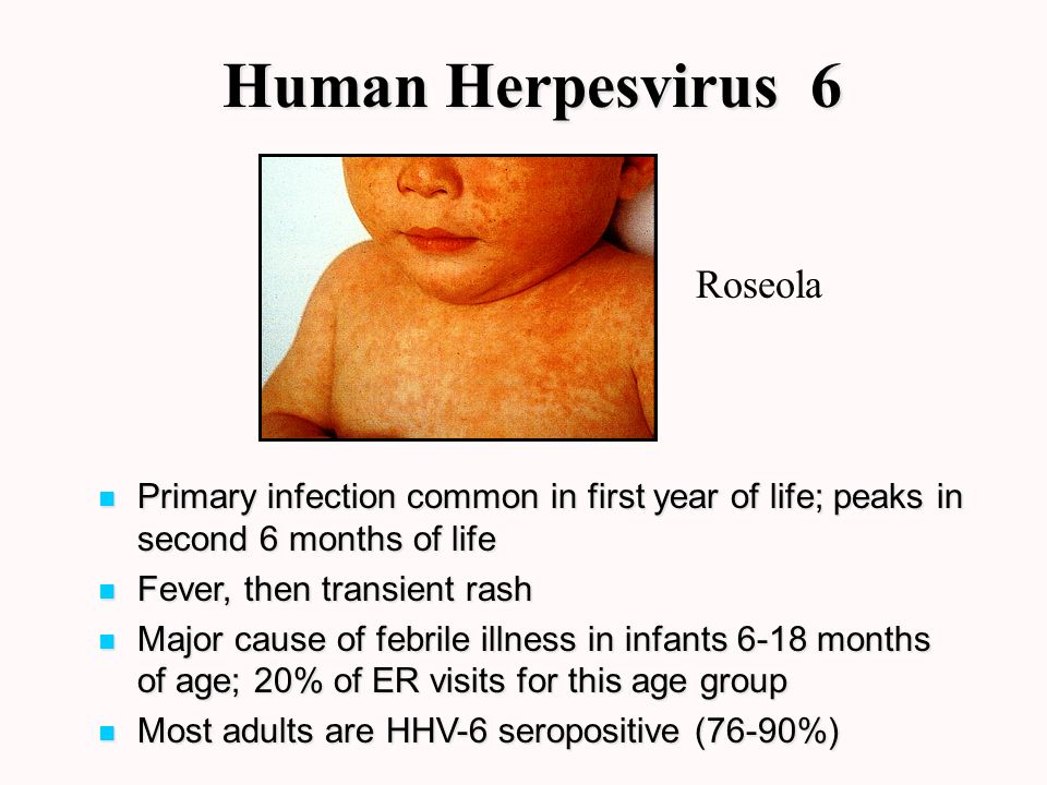Pediatrics Notes Introduction to Herpesvirus 6 Infection