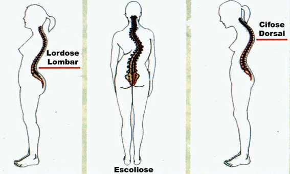 Resultado de imagem para lordose