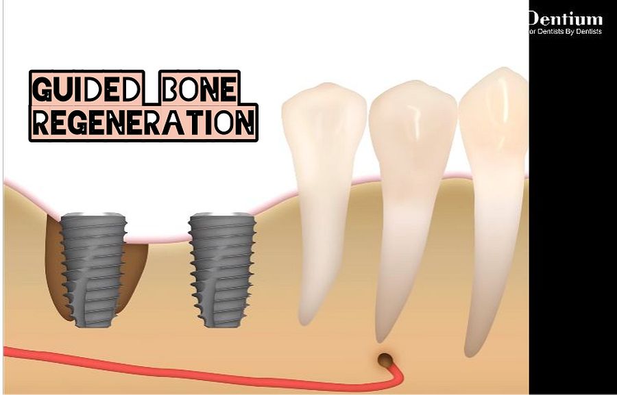 GUIDED BONE REGENERATION Immediate implantation Dr. Teddy