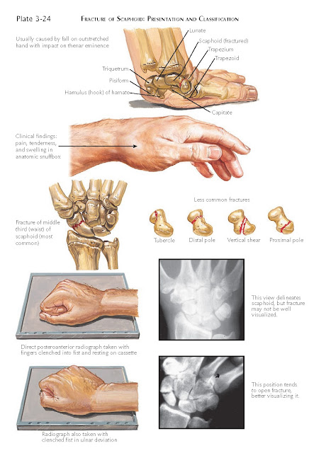 FRACTURE OF SCAPHOID