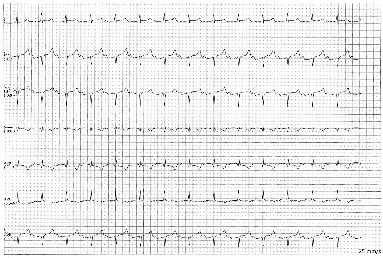 Sinus rhythm with a first degree block