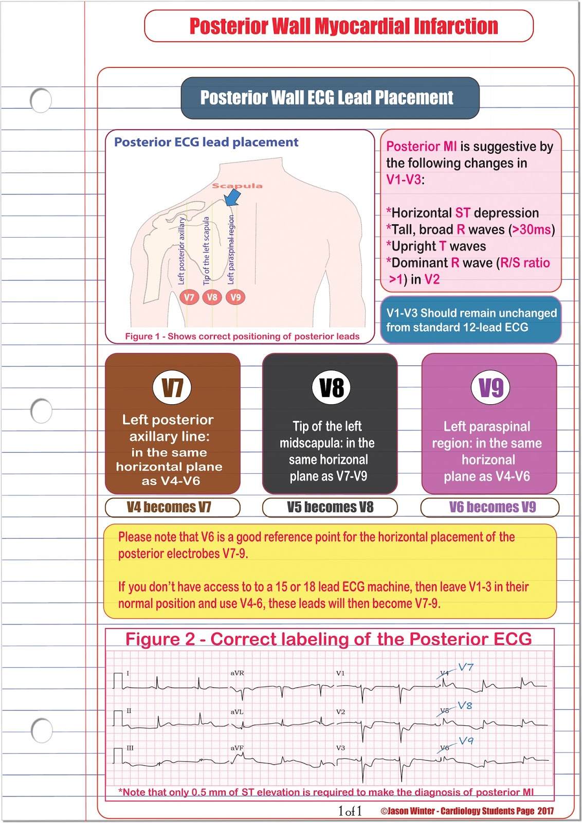 ECG Educator Blog : Posterior ECG Lead Placement