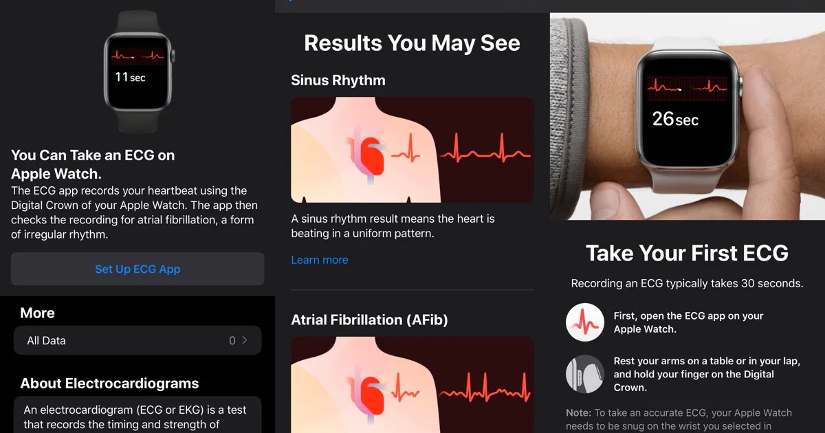 apple watch ecg hack