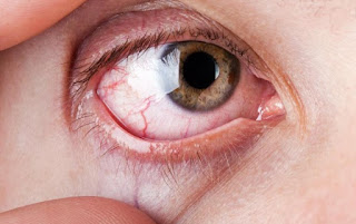 Sakit Mata Sebelah Kanan Menurut Islam ( Ustad Danu ) dan Obatnya