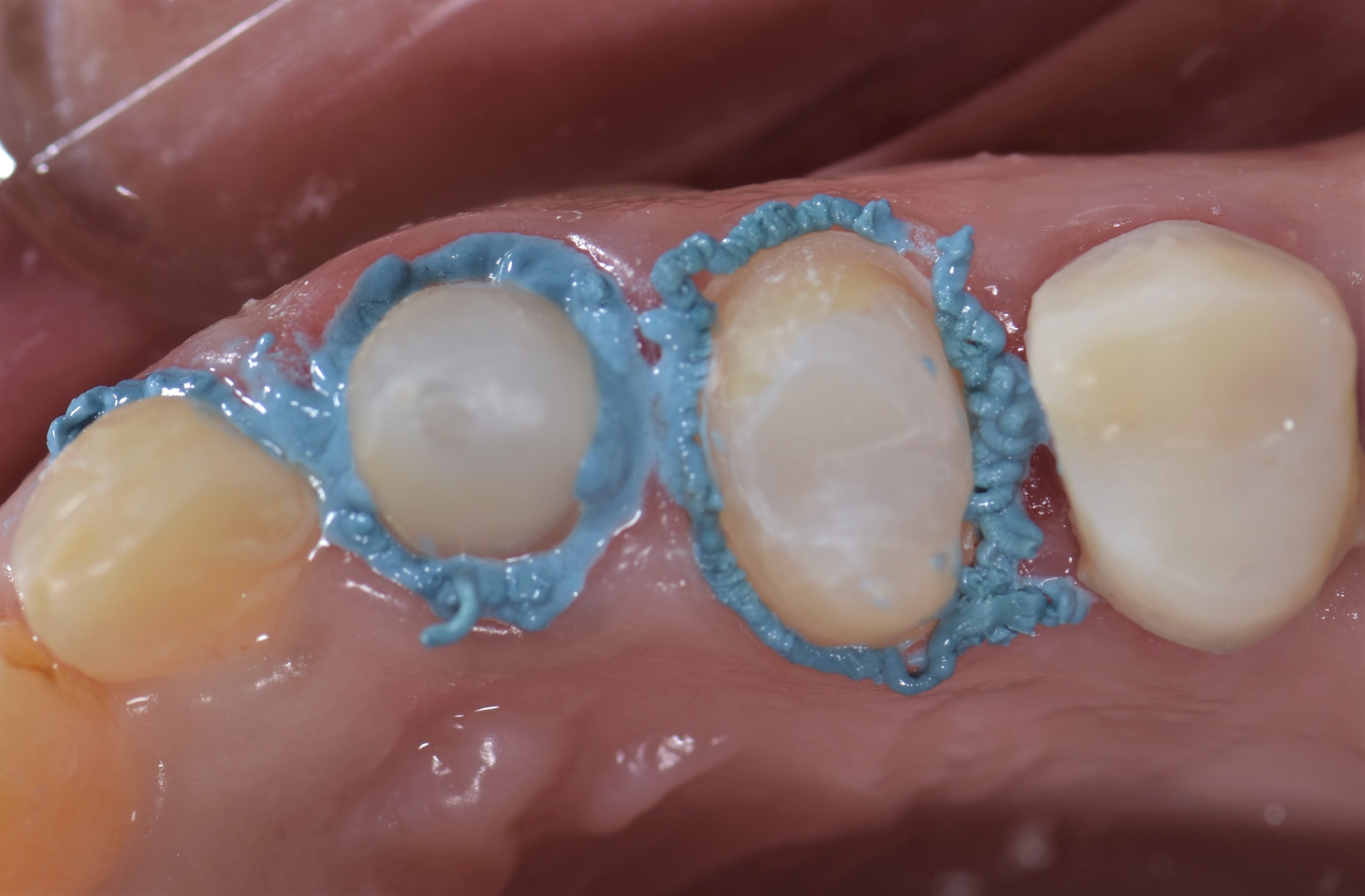 Retraction cords.. Why? When? How? Dental Esthetics