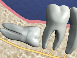 Chữa trị răng khôn mọc bất thường Tfds