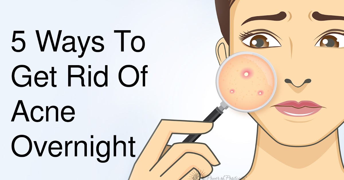How to Get Rid of Acne Overnight by Yourself