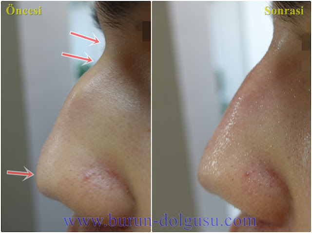 Burun Kökü Dolgusu - Burun Dolgusu - Dolguyla Burun estetiği - Non-surgical Nose Job In Istanbul - Dolgu İle Burun Ucu Kaldırma - Burun Ucu Dolgusu - Burun Dolgusu Fiyatı - Ameliyatsız Burun Estetiği - Burun Dolgusu Fiyatları - Dolgu İle Burun Kaldırma - Dolgu İle Burun Düzeltme