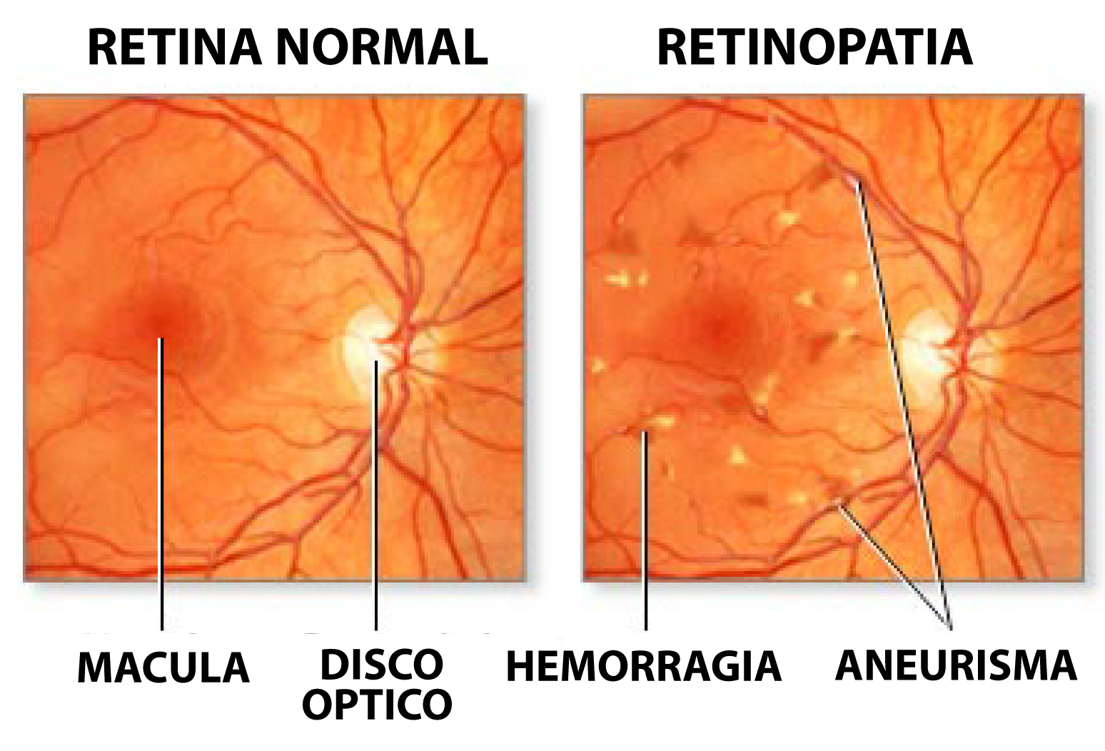 Сетчатки обоих глаз. Гипертоническая ретинопатия сетчатки. Ангиопатия и ретинопатия сетчатки. Ангиопатия сетчатки глазное дно. Гипертоническая и диабетическая ретинопатия.