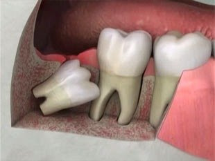 Nguyên nhân răng khôn mọc lệch