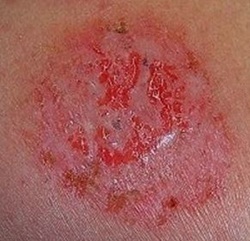 Cara mengobati gatal di sekitar kemaluan wanita - tamba teka laral unga