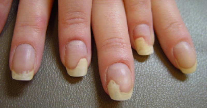 Mani Pedi Studio Onycholiza Czym Jest I Jak Ja Leczyc