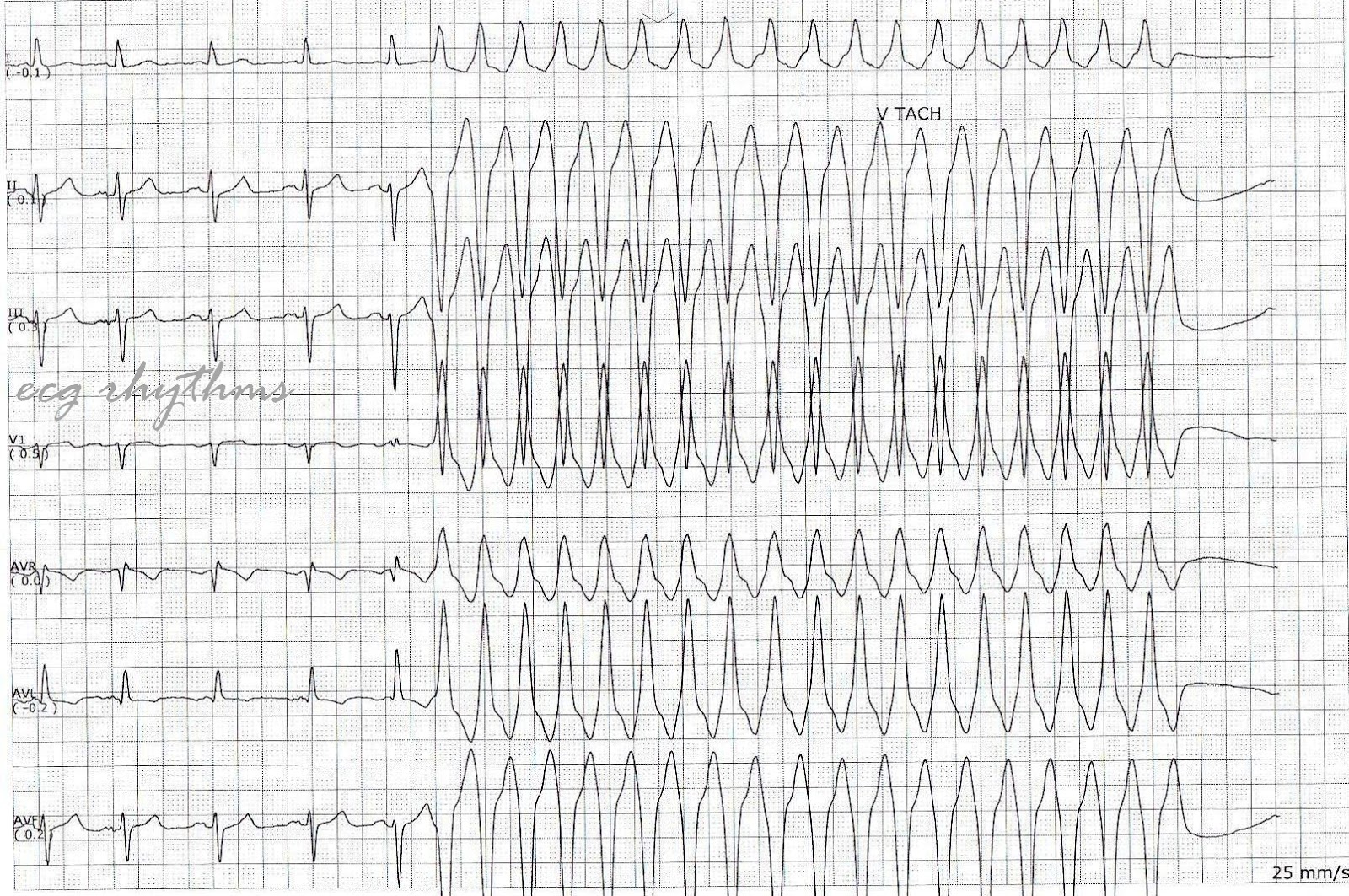 Ecg Rhythms Basic Ecg Interpretation