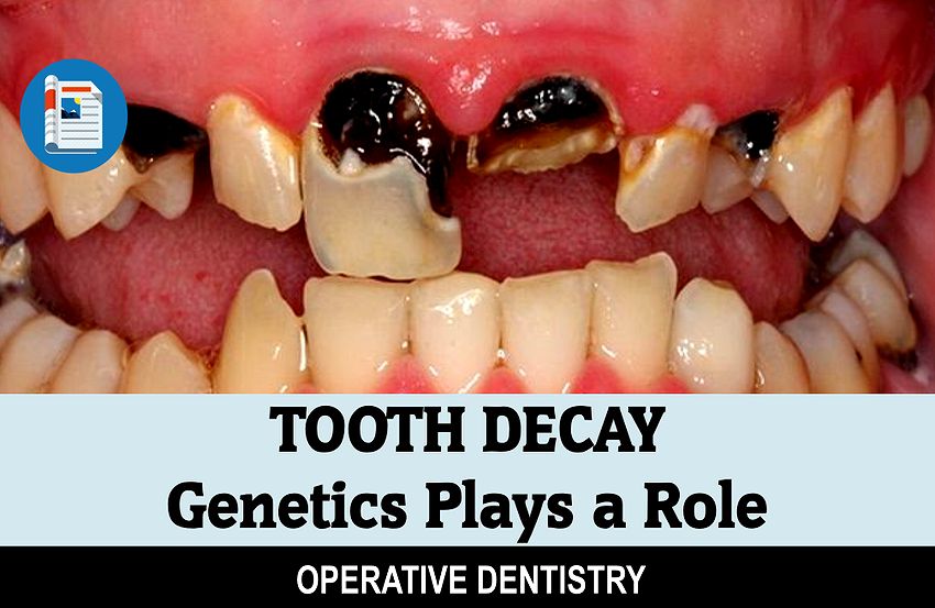 TOOTH DECAY Plays a Role