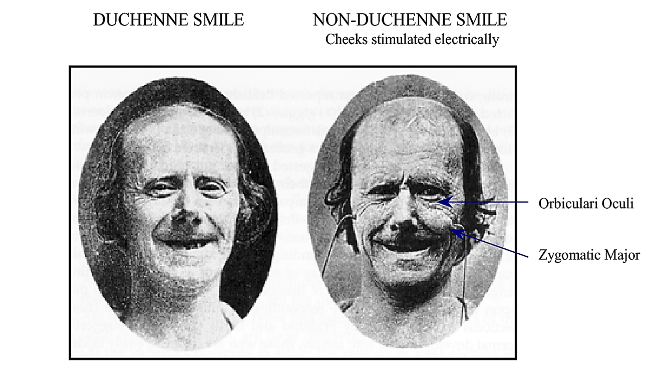 дюшеновская улыбка. дюшен де булонь улыбка. маркер дюшенна при улыбке. искренняя улыбка дюшенн. маркер дюшенна улыбка.