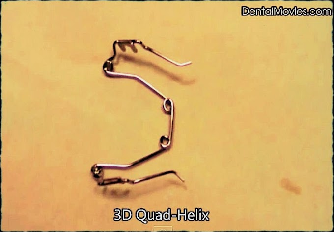 ORTHODONTICS: Insertion of the Wilson 3D Quad-Helix Appliance