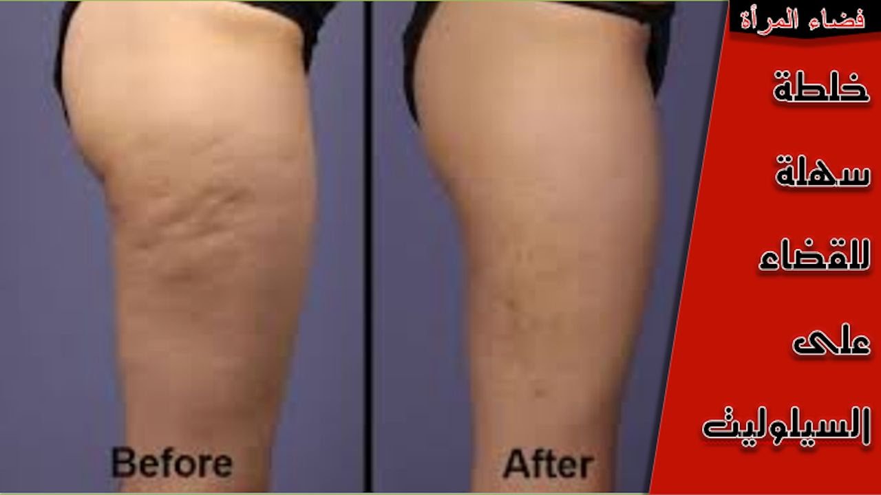 علاج السيلوليت بخلطة سهلة لإزالة السيلوليت
