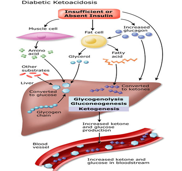 Definisi dan Tipe Diabetes