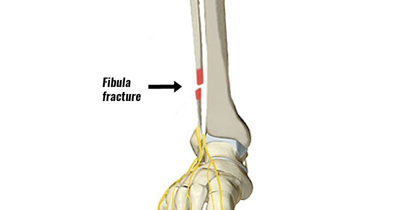 Fibula Nedir Fibula Kirigi Nedir Fibula Kirigi Tedavisi Nasil Olur Fibula Nedir Fibula Kirigi Nedir Fibula Kirigi Tedavisi Nasil Olur