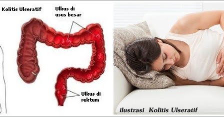 
Pengobatan Tradisional Kolitis Ulseratif  Terbaru dan Mujarab | Spesialis Pengobatan Tradisional
