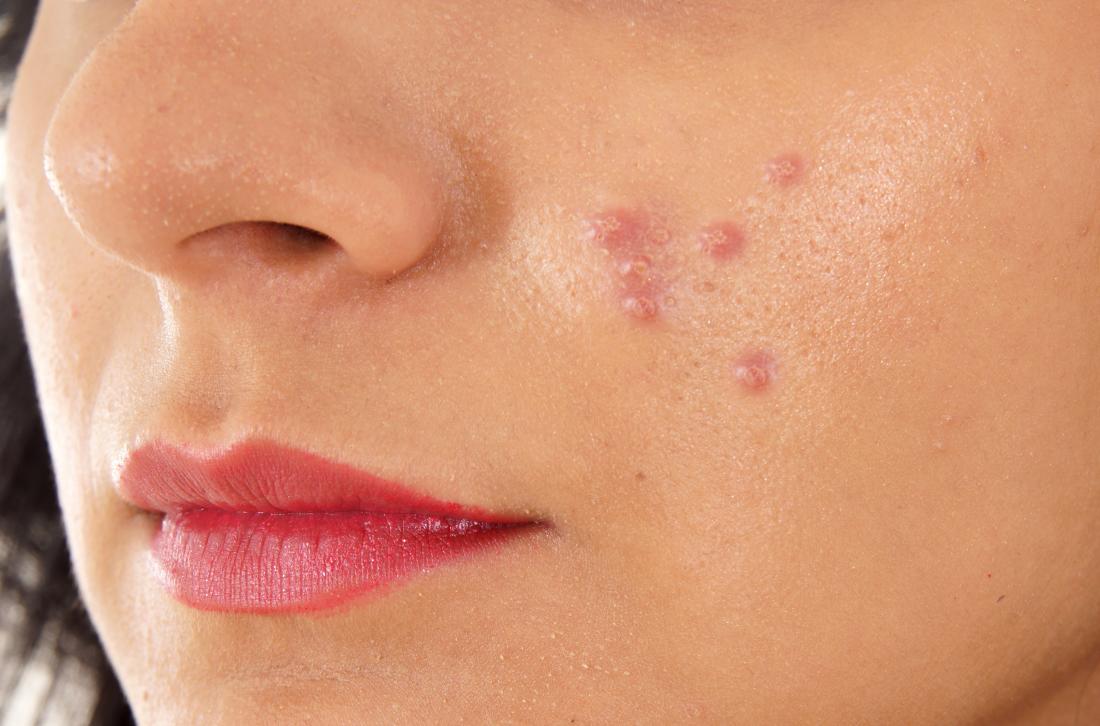 How To Prevent Pimples: The Secret You Should Know.