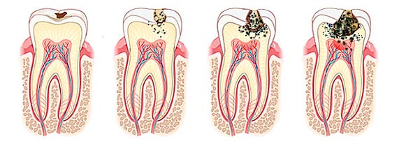 Pulpitis - e-Medical